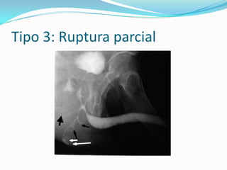 TRAUMA URETRALLESION DE URETRA ANTERIORLas lesiones en la uretra anterior están causadas porRelaciones sexuales (con fractura de cuerpos cavernosos)Traumatismo durante la penetración Colocación de bandas constrictoras en el pene.IATROGENICAS