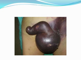 Lesión de uretra anterior