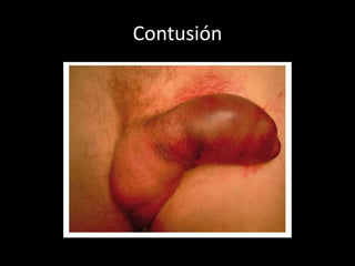Contusión
 