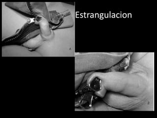Estrangulacion
 
