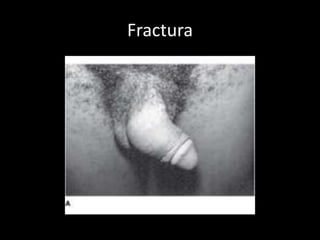 Fractura
 