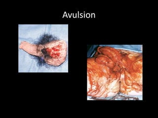 Avulsion
 