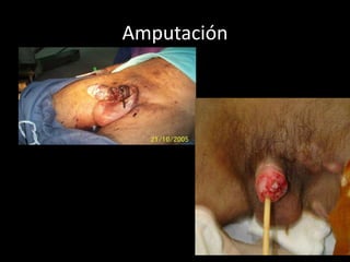 Amputación
 