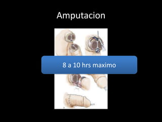 Amputacion



 8 a 10 hrs maximo
 