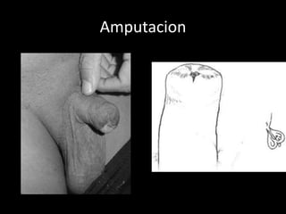 Amputacion
 