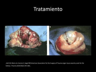 Tratamiento




,Safir M, Mario LA, Service S, Segal MR.American Association for the Surgery of Trauma organ injury severity scale for the
kidney. J Trauma 2010;50(2):195-200.
 