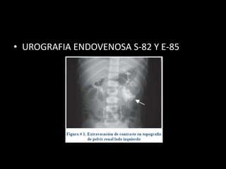 • UROGRAFIA ENDOVENOSA S-82 Y E-85
 