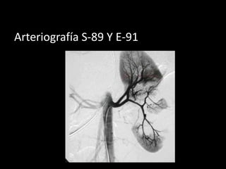 Arteriografía S-89 Y E-91
 