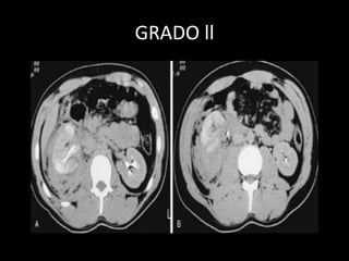 GRADO ll
 