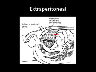Extraperitoneal
 