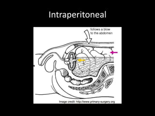 Intraperitoneal
 