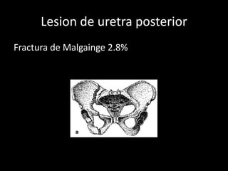 Lesion de uretra posterior
Fractura de Malgainge 2.8%
 