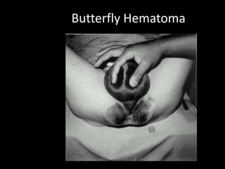 Butterfly Hematoma
 