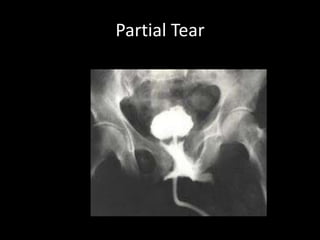 Partial Tear
 