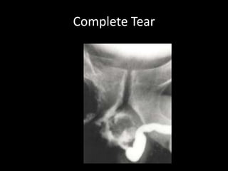 Complete Tear
 