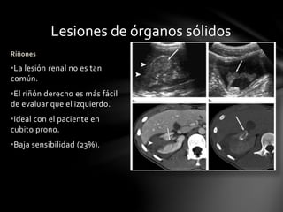 Lesiones de órganos sólidos
Riñones
•La lesión renal no es tan
común.
•El riñón derecho es más fácil
de evaluar que el izquierdo.
•Ideal con el paciente en
cubito prono.
•Baja sensibilidad (23%).
 