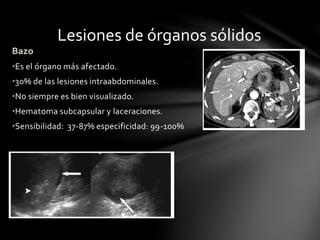 Lesiones de órganos sólidos
Bazo
•Es el órgano más afectado.
•30% de las lesiones intraabdominales.
•No siempre es bien visualizado.
•Hematoma subcapsular y laceraciones.
•Sensibilidad: 37-87% especificidad: 99-100%
 