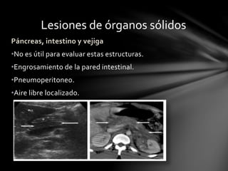 Lesiones de órganos sólidos
Páncreas, intestino y vejiga
•No es útil para evaluar estas estructuras.
•Engrosamiento de la pared intestinal.
•Pneumoperitoneo.
•Aire libre localizado.
 
