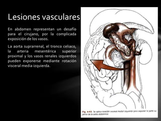 En abdomen representan un desafío
para el cirujano, por la complicada
exposición de los vasos.
La aorta suprarrenal, el tronco celiaco,
la arteria mesentérica superior
proximal y los vasos renales izquierdos
pueden exponerse mediante rotación
visceral media izquierda.
Lesiones vasculares
 