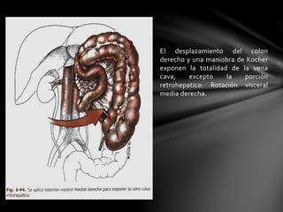 El desplazamiento del colon
derecho y una maniobra de Kocher
exponen la totalidad de la vena
cava, excepto la porción
retrohepatica: Rotación visceral
media derecha.
 
