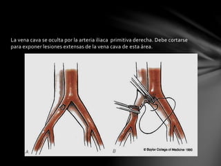 La vena cava se oculta por la arteria iliaca primitiva derecha. Debe cortarse
para exponer lesiones extensas de la vena cava de esta área.
 