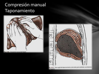 Compresión manual
Taponamiento
 