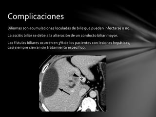 Biliomas son acumulaciones loculadas de bilis que pueden infectarse o no.
La ascitis biliar se debe a la alteración de un conducto biliar mayor.
Las fístulas biliares ocurren en 3% de los pacientes con lesiones hepáticas,
casi siempre cierran sin tratamiento específico.
Complicaciones
 