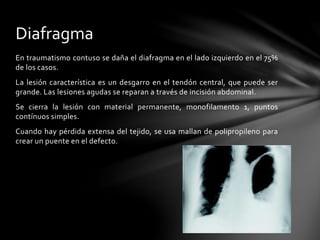 En traumatismo contuso se daña el diafragma en el lado izquierdo en el 75%
de los casos.
La lesión característica es un desgarro en el tendón central, que puede ser
grande. Las lesiones agudas se reparan a través de incisión abdominal.
Se cierra la lesión con material permanente, monofilamento 1, puntos
contínuos simples.
Cuando hay pérdida extensa del tejido, se usa mallan de polipropileno para
crear un puente en el defecto.
Diafragma
 