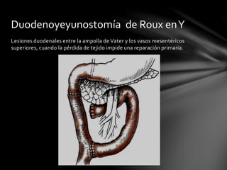 Lesiones duodenales entre la ampolla de Vater y los vasos mesentéricos
superiores, cuando la pérdida de tejido impide una reparación primaria.
Duodenoyeyunostomía de Roux enY
 