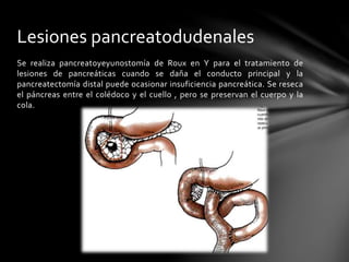 Se realiza pancreatoyeyunostomía de Roux en Y para el tratamiento de
lesiones de pancreáticas cuando se daña el conducto principal y la
pancreatectomía distal puede ocasionar insuficiencia pancreática. Se reseca
el páncreas entre el colédoco y el cuello , pero se preservan el cuerpo y la
cola.
Lesiones pancreatodudenales
 