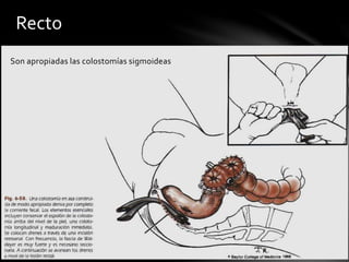 Son apropiadas las colostomías sigmoideas
Recto
 