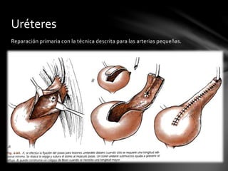 Reparación primaria con la técnica descrita para las arterias pequeñas.
Uréteres
 