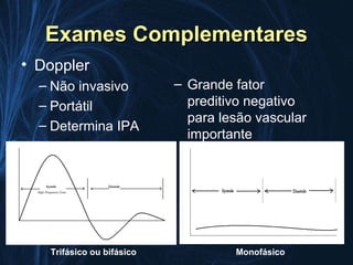 Exames Complementares
• Doppler
  – Não invasivo           – Grande fator
  – Portátil                 preditivo negativo
                             para lesão vascular
  – Determina IPA
                             importante




   Trifásico ou bifásico            Monofásico
 