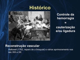 Histórico
                                                Controle da
                                                hemorragia
                                                      =
                                               cauterização
                                               e/ou ligadura



Reconstrução vascular
 Hallowel (1762, reparo de a braquial) e vários aprimoramento nos
 séc XIX e XX
 