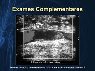 Exames Complementares




Trauma contuso com trombose parcial da artéria femoral comum E
 