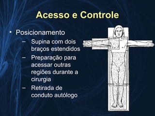 Acesso e Controle
• Posicionamento
   – Supina com dois
     braços estendidos
   – Preparação para
     acessar outras
     regiões durante a
     cirurgia
   – Retirada de
     conduto autólogo
 