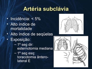 Artéria subclávia
• Incidência: < 5%
• Alto índice de
  mortalidade
• Alto índice de seqüelas
• Exposição:
    – 1º seg dir:
      esternotomia mediana
    – 1º seg esq:
      toracotomia ântero-
      lateral E
 