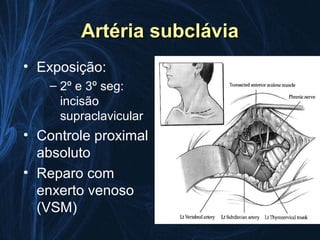 Artéria subclávia
• Exposição:
    – 2º e 3º seg:
      incisão
      supraclavicular
• Controle proximal
  absoluto
• Reparo com
  enxerto venoso
  (VSM)
 