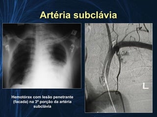 Artéria subclávia




Hemotórax com lesão penetrante
 (facada) na 3ª porção da artéria
            subclávia
 