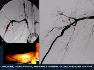 50a, masc, trauma contuso, hematoma e isquemia. Enxerto axilo-axilar com VBII
 