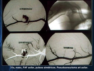 31a, masc, FAF axilar, pulsos simétricos. Pseudoaneurisma art axilar.
 