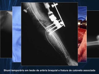 Shunt temporário em lesão de artéria braquial e fratura de cotovelo associada
 