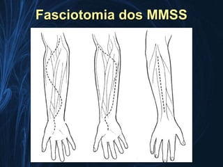 Fasciotomia dos MMSS
 