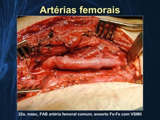 Artérias femorais




22a, masc, FAB artéria femoral comum, enxerto Fe-Fe com VSMII
 