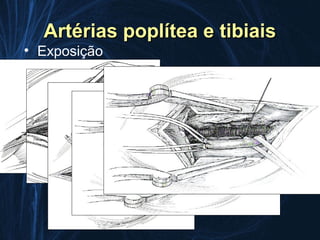 Artérias poplítea e tibiais
• Exposição
 