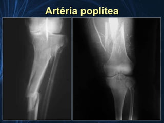 Artéria poplítea
 