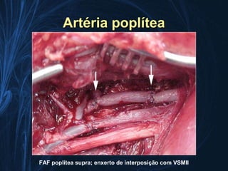 Artéria poplítea




FAF poplítea supra; enxerto de interposição com VSMII
 
