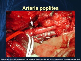 Artéria poplítea




Fratura-luxação posterior de joelho. Secção de AP justa-articular. Anastomose T-T
 