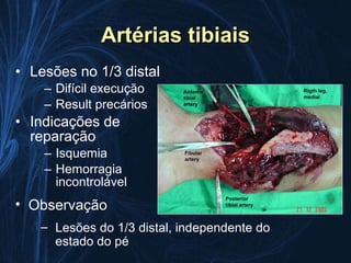 Artérias tibiais
• Lesões no 1/3 distal
    – Difícil execução
    – Result precários
• Indicações de
  reparação
    – Isquemia
    – Hemorragia
      incontrolável
• Observação
   – Lesões do 1/3 distal, independente do
     estado do pé
 