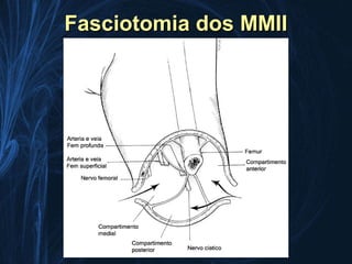 Fasciotomia dos MMII
 